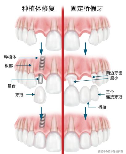 种植牙齿的方法和时间要求-种植牙方法哪些效果好