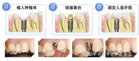 种植牙齿的方法和时间要求-种植牙方法哪些效果好