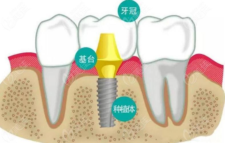 不切牙龈的种植牙方法-不切牙龈的种植牙方法图片