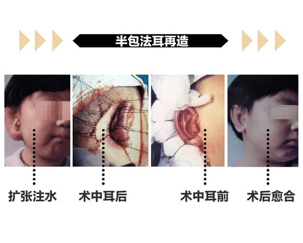 截儿根种植方法-截根术图片